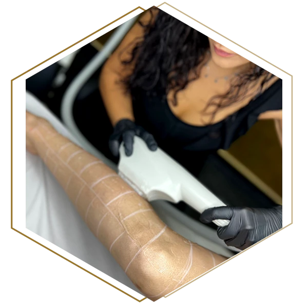 Mujer recibiendo un tratamiento de estética depilación láser SHR